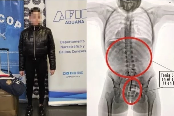 Arjantin Havalimanında 20 Yaşındaki Kadın Vajina ve Midesine Sakladığı Kokainle Yakalandı 1 Arjantin Havalimanında 20 Yaşındaki Kadın Vajina ve Midesine Sakladığı Kokainle Yakalandı
